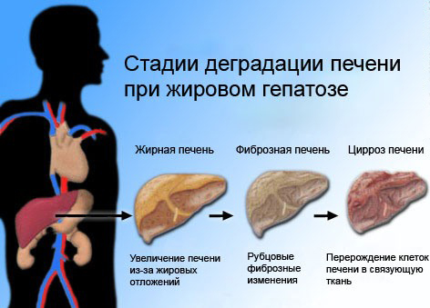 fatty-liver-cirrhosis_2 (472x339, 93Kb)