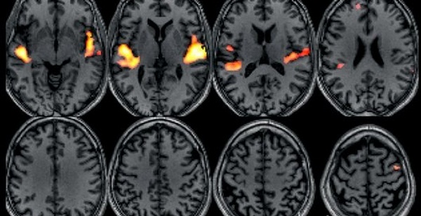 C0071660-Hearing_music-fMRI_brain_scan-SPL (600x308, 71Kb)