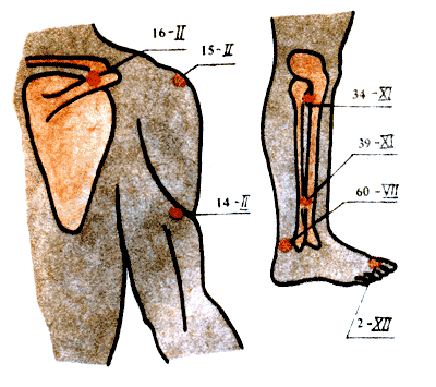 osteohondroz-akupunktura-2 (400x355, 34Kb)