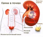 Может ли от водопроводной воды образовываться камни в почках thumbnail