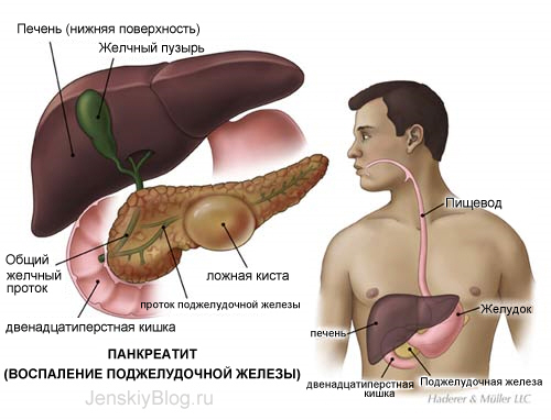 3324853_vospaleniepodzheludochnojzhelezy (500x382, 81Kb)