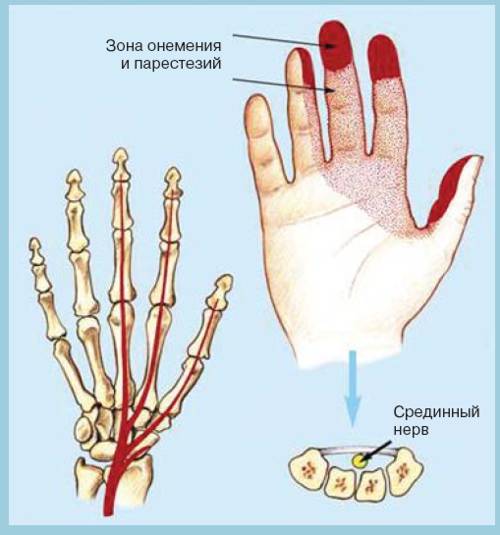 Синдром карпального клапана кисти