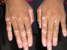 vitiligo (259x194, 6Kb)