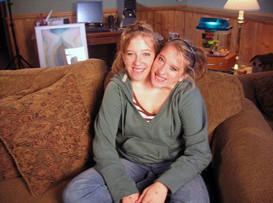 Одна жизнь на двоих: сиамские близнецы Эбигейл и Бриттани Хенсел