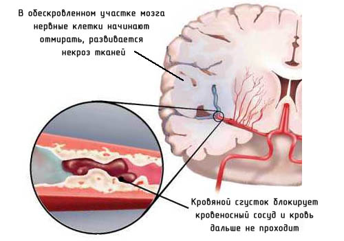 3407372_posle_insulta (500x351, 53Kb)