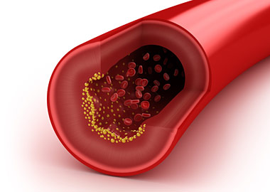 cholesterol_plaque (380x270, 20Kb)