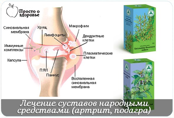 Народные методы лечения коленного сустава. Препараты при артрите и артрозе коленного сустава. Артрит коленного сустава лекарства. Препараты при артрите коленного сустава. Артрит суставов народными средствами.