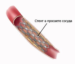 stent-v-vene (250x215, 42Kb)
