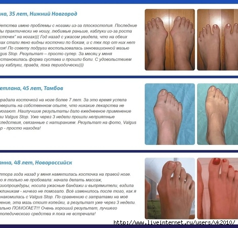      ,   3 ,    ,   ,   valgus plus  ,   ,   , valgus plus   ,   ,     , hallux valgus  , hallux valgus  ,     ,      ,         ,  pro ,      , hallux valgus    , valgus pro   ,  valgus pro  ,      ,      ,