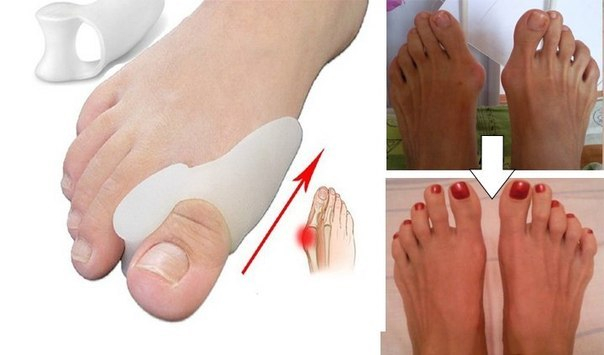 valgus plus ,   ,    , valgus pro  , hallux valgus night,      , hallux valgus,    hallufix, valgus plus   , valgus plus    ,   ,    ,  valgus pro , hallux valgus  ,  hallux valgus ,      , hallux valgus night splint ,  valgus pro  ,     ,  valgus ,  ,