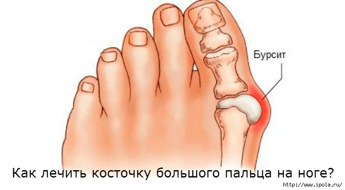alt="Как лечить косточку большого пальца на ноге?"/2835299_Kak_lechit_kostochky_bolshogo_palca_na_noge (700x385, 104Kb)