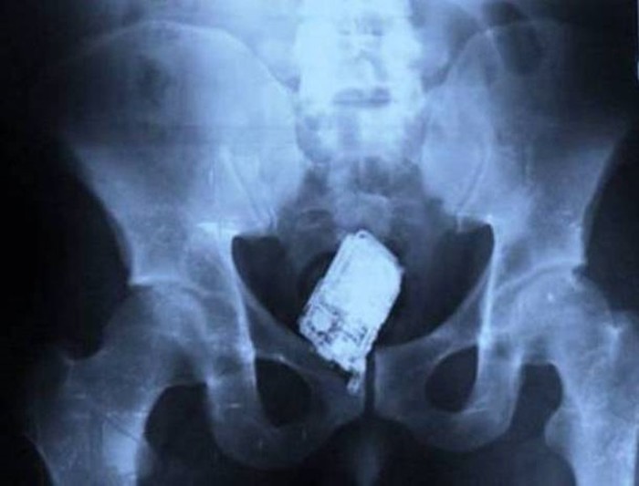 Самые необычные рентгеновские снимки — мобильные телефоны и боевые гранаты внутри пациентов