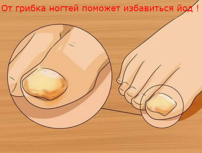 alt="От грибка ногтей поможет избавиться йод !"/2835299_Ot_gribka_nogtei_pomojet_izbavitsya_iod__dostatochno_3_procedyri (700x531, 221Kb)