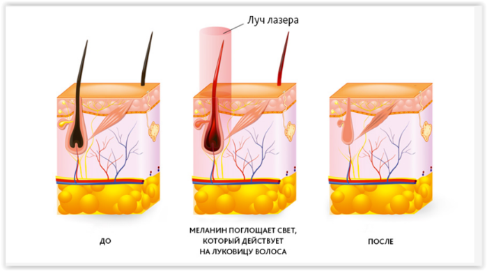 Безопасная лазерная эпиляция диодным лазером в клинике  Cosmetomed в Москве - http://www.cosmetomed.ru