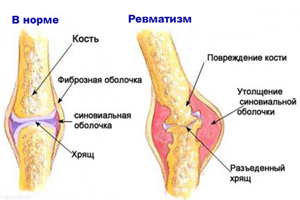 3407372_revmatizm56 (300x200, 29Kb)