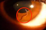  Woman-filmed-with-nematode-worm-inside-her-eye (615x411, 81Kb)