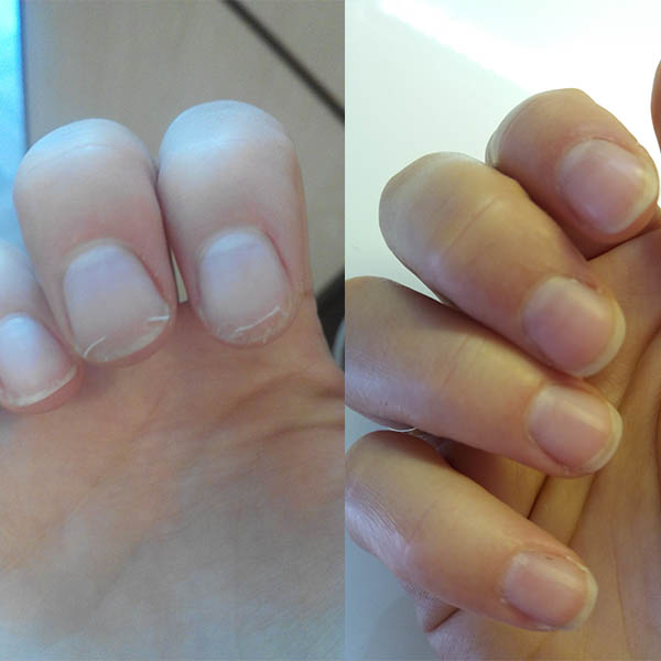 Ногти после геля стали тонкие. Маникюр до и после. Отхождение ногтевой пластины.