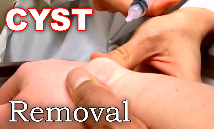 GANGLION CYST (700x422, 262Kb)