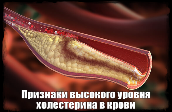 131684660_2835299_Priznaki_visokogo_yrovnya_holesterina_v_krovi (699x457, 394Kb)