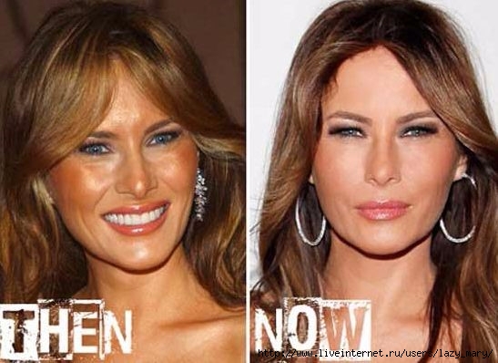 Melania-Trump-before-and-after-plastic-surgery-21 (547x398, 127Kb)