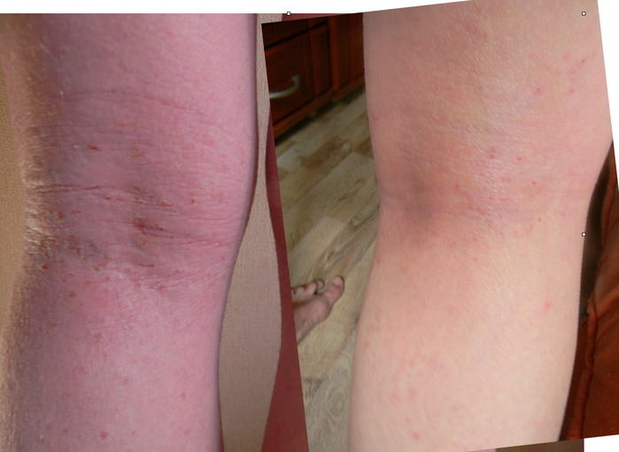 Atopic dermatitis. Treatment on Skype. (700x511, 365Kb)