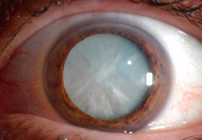 cataract (670x467, 207Kb)