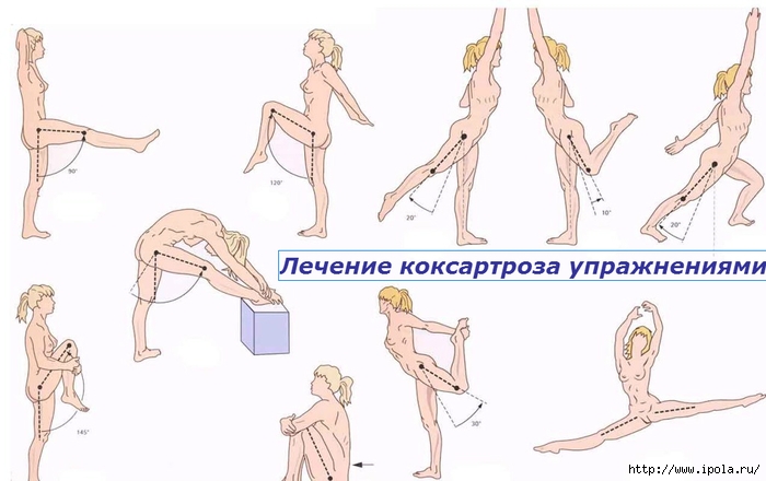 alt="Лечение коксартроза упражнениями"/2835299_Lechenie_koksartroza_yprajneniyami (700x440, 155Kb)