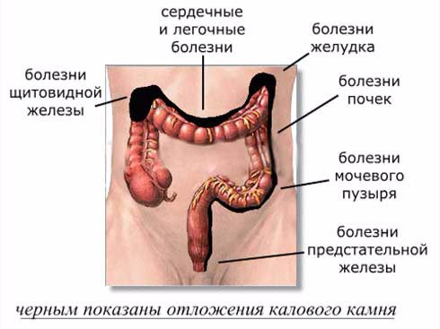 Ochischenie-kishechnika (490x367, 103Kb)