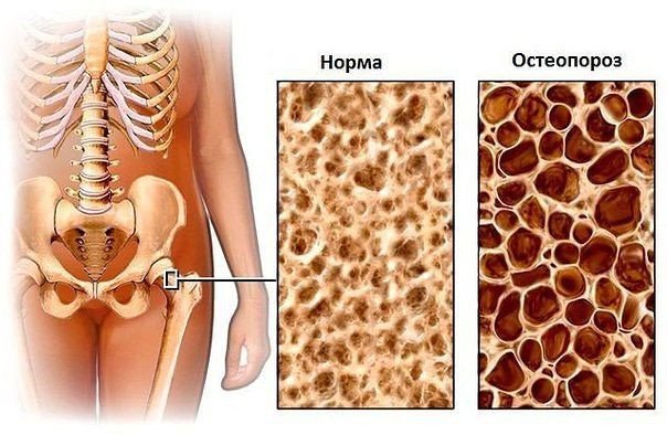 osteoporoz (604x394, 66Kb)