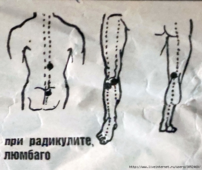 Люмбаго с ишиасом поясничного отдела