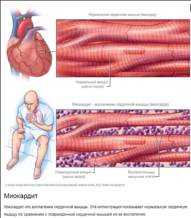 Миокардит картинки для презентации