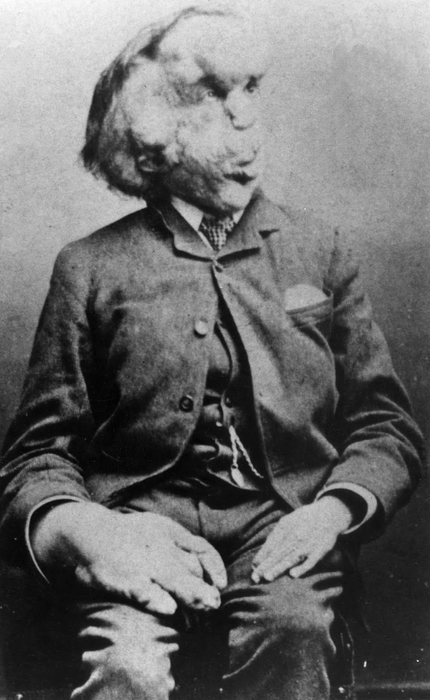 Joseph_Merrick (430x700, 181Kb)