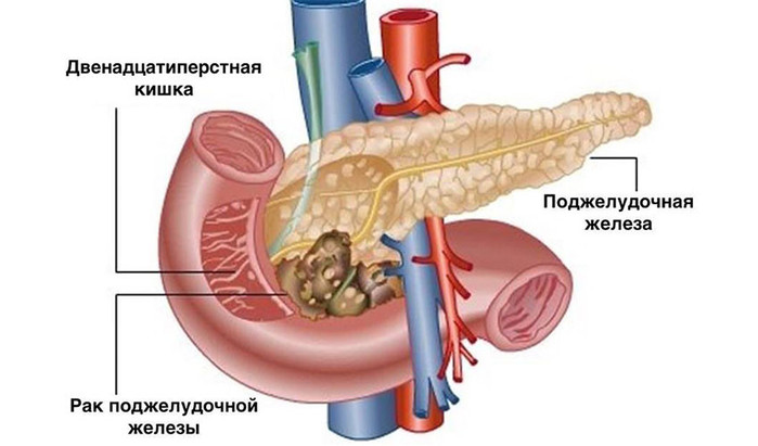 rak-podjeludok-01102019 (700x411, 57Kb)